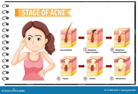 Stages Of Skin Acne Anatomy With A Woman Doing Stressful Pose Stock