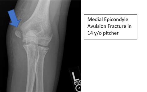 Medial Epicondyle Fracture