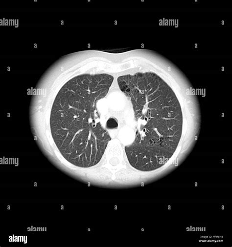 Abnormal Lung Ct Hi Res Stock Photography And Images Alamy