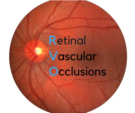 Retinal Vascular Occlusions Rvo All About Your Eyes