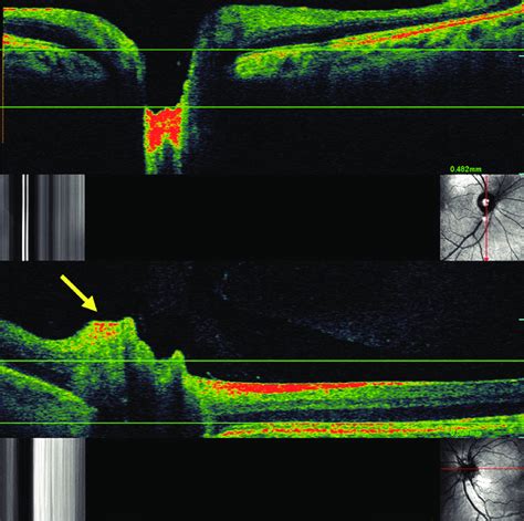 Optical Coherence Tomographyscanning Laser Ophthalmoscopy Octslo Of