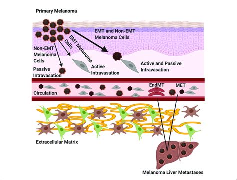 Melanoma Metastasis Three Routes Of Primary Melanoma Dissemination
