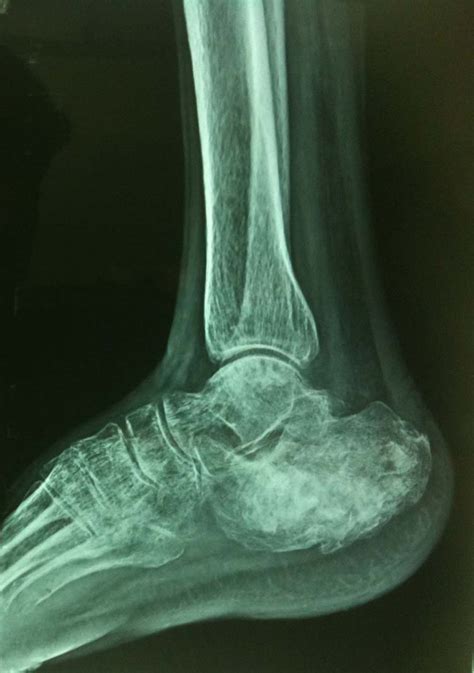 A Rare Case Of Aneurysmal Bone Cyst Of The Calcaneum The Foot And