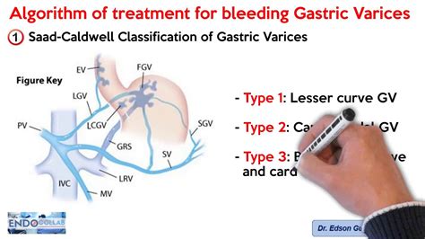 Algorithm Of The Treatment For Bleeding Gastric Varices Youtube