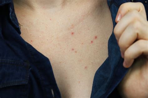 How To Treat Chest Acne According To Dermatologists Popsugar Beauty