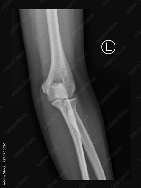 Film X Ray Radiograph Of Elbow Show Normal Human Anatomy Of Elbow Arm