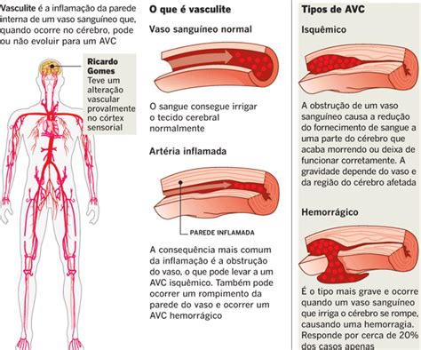 Vasculite sintomas causas e tratamento Clìnica Geral Doutìssima