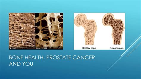 Bone Health Prostate Cancer And You Youtube