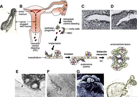 Pathogenesis Of Deep Endometriosis Fertility And Sterility
