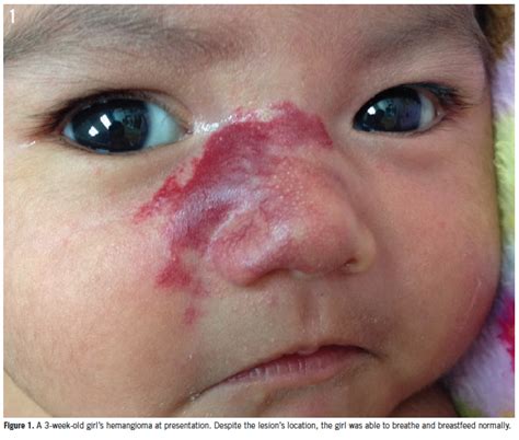 infantile hemangioma management of a girl s growing facial lesion consultant360