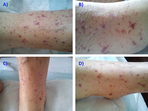 Cureus Leukocytoclastic Vasculitis With Systemic Involvement