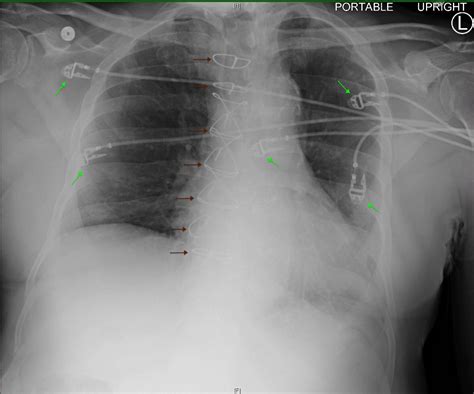 Pulmonary Embolism X Ray Westermark Sign In Pulmonary Embolism Nejm