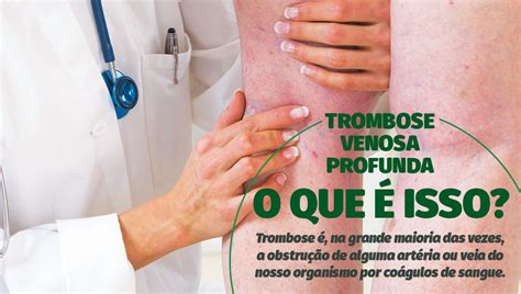 Richtlijnen voor de preventie, diagnostiek en behandeling van diepveneuze trombose en longembolie. Trombose venosa profunda: o que é isso? - Santa Casa de ...