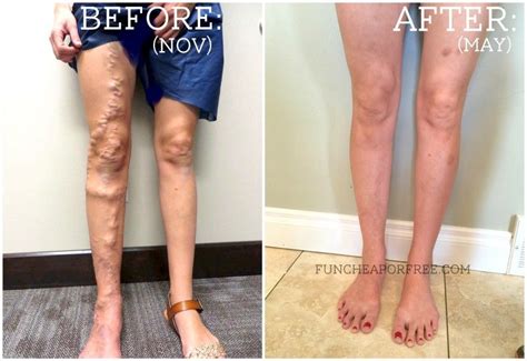 My Varicose Veins Story Your Questions Answered Fun Cheap Or Free