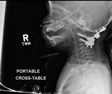 Check That Neck Cervical Spine Imaging Radiology Key