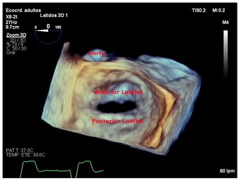 Jcdd Free Full Text The Role Of 2d And 3d Echo In Mitral Stenosis