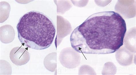 Auer bodies have been reported in several clinical studies to be the single most important favourable prognostic parameter for induction remission rate and survival duration in patients with acute myeloid. WBC Anomalies and Lab Evaluation at Armstrong Atlantic ...