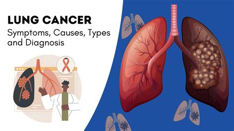Lung Cancer Symptoms Causes Types And Diagnosis Sprint Medical