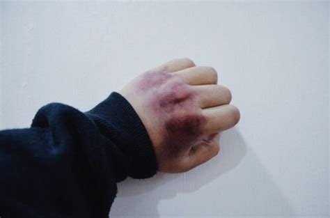 Bruised Aesthetic