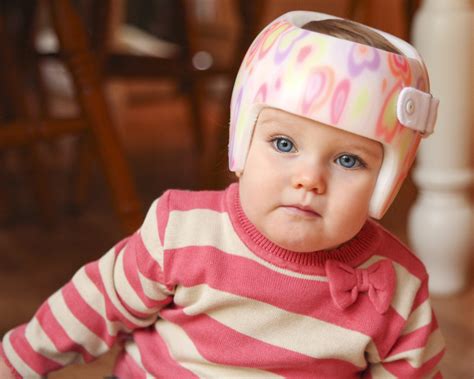 Incidence Of Plagiocephaly In Infants As High As 466