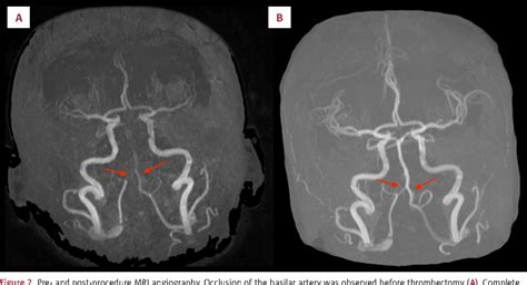 Figure 2 From Endovascular Treatment Of Basilar Artery Thrombosis