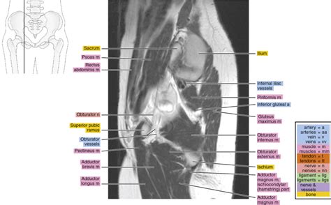 Mri Of The Female Pelvis Radiology Key