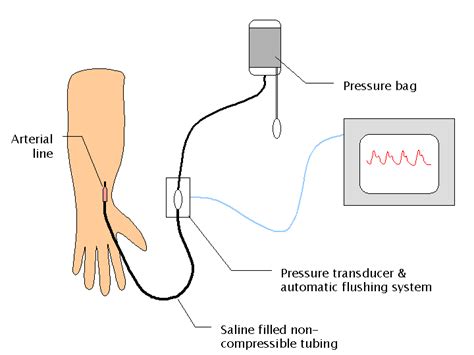 Arterial Blood Pressure Measurement An Intra Arterial Catheter Aka
