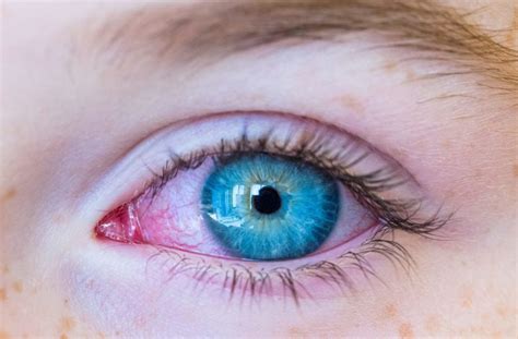 What Can Cause Red Eyes In A Child Calgary