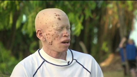 Malawis Albinos At Risk Of Total Extinction Un Warns Cnn