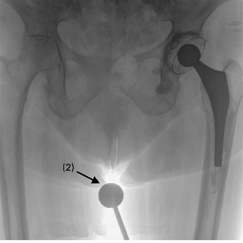 Standing Anteroposterior Pelvic Radiograph Showing The Calibration Ball