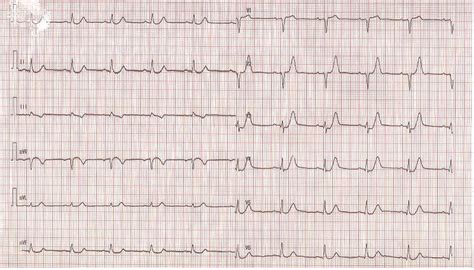 Represents an acute proximal occlusion (unlike wellen's sign which represents a subacute process). The de Winter T waves - an unusual presentation of left ...