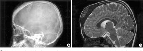 Figure 1 From Osteosarcoma Of The Skull Resembling Desmoplastic Fibroma