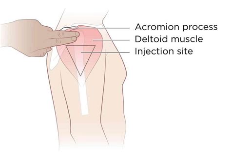 intramuscular injection definition and patient education patient education injections im