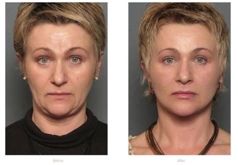 How Can I Lift Sagging Jowls Stein Plastic Surgery