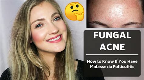 How To Know If You Have Malassezia Folliculitis Fungal Acne Tiny