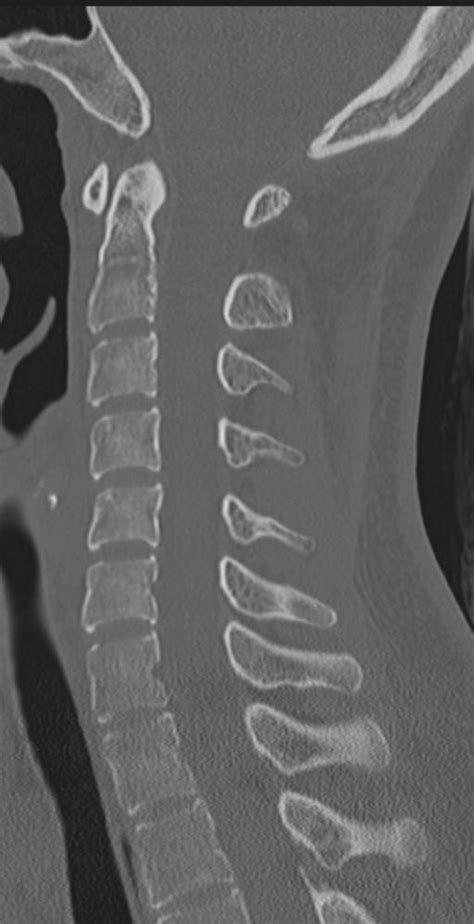 Normal Cervical Spine CT Image Radiopaedia Org