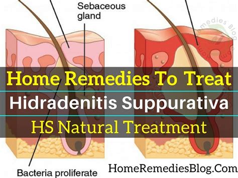 11 Natural Home Remedies For Hidradenitis Suppurativa With Diet Plan