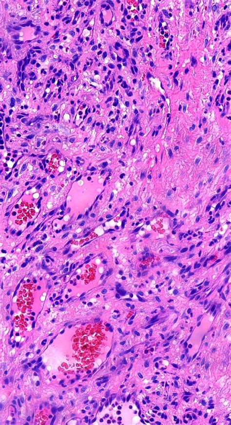 Pathology Of Pyogenic Granuloma Pathology Blog