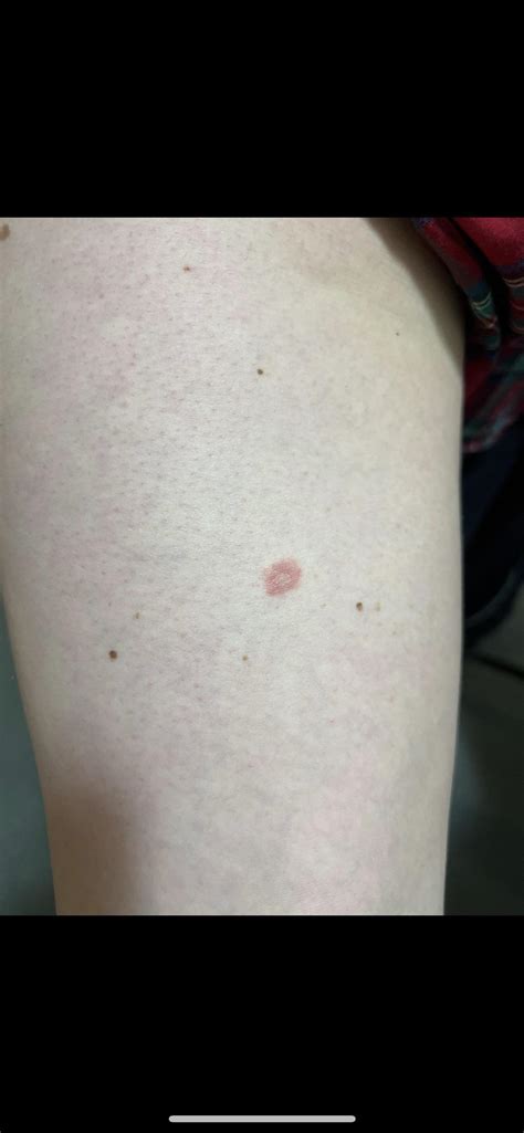 Is This Ringworm Just Noticed This Patch On My Leg — Not Itchy At All