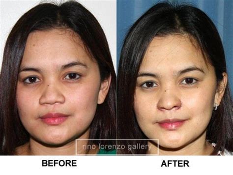 To redefine the jawline, chin was reshaped by installing a medical grade silicone implant. Rhinoplasty - Philippine Cosmetics
