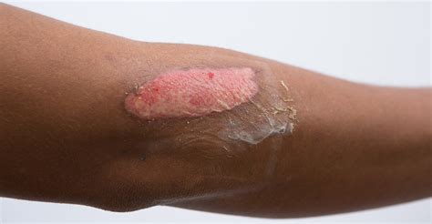 Unpacking The Fundamentals Of Burn Wounds Wcei