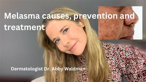 Melasma Causes Prevention And Treatment Dermatologist Explains Youtube