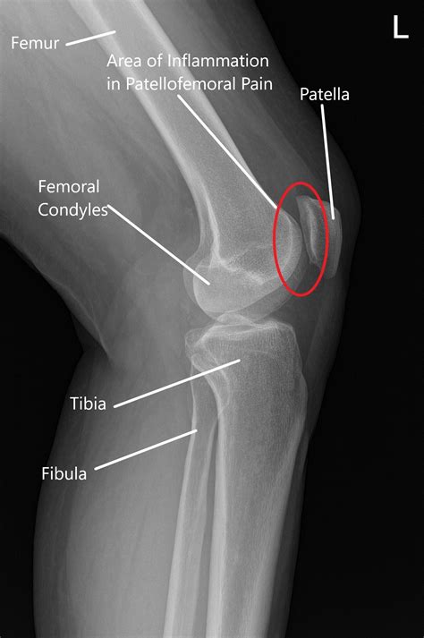 Knee Xray Displays Basic Knee Joint Anatomy Including Vrogue Co