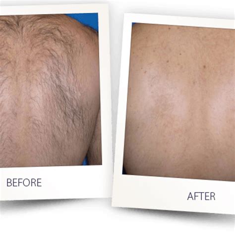 Laser Hair Removal For Men Vs Medspa Laser Hair Removal Clinic