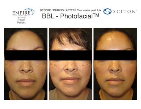 Forever Young Bbl Photofacial In Bakersfield Empire Eye And Laser