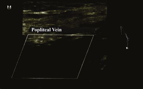 A Venous Doppler Ultrasound Of Left Lower Extremity Popliteal Vein