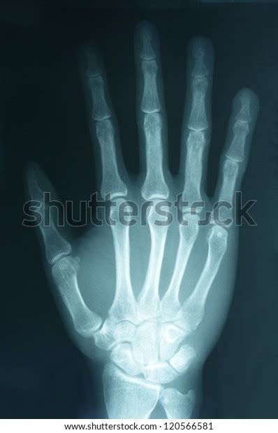 Xray Image Human Right Hand Stock Photo 120566581 Shutterstock