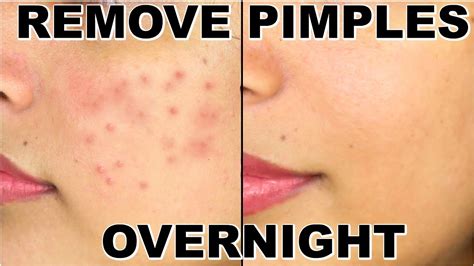 How To Remove Pimples Fast Best Home Remedies For Pimples Remove