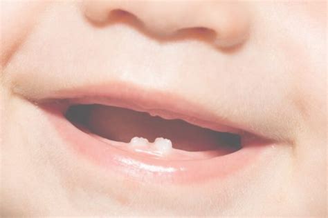 Dentición Temporal Y Permanente¿qué Son Y Diferencias Entre Ambas