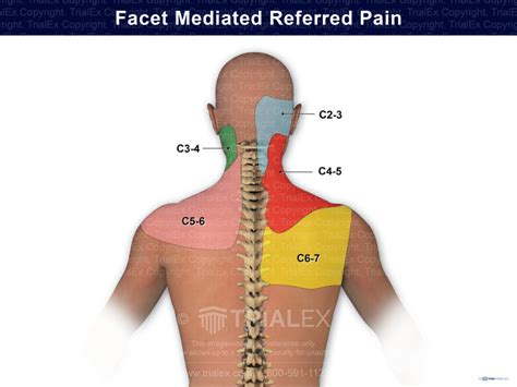 Faceted Mediated Referred Pain Trial Exhibits Inc